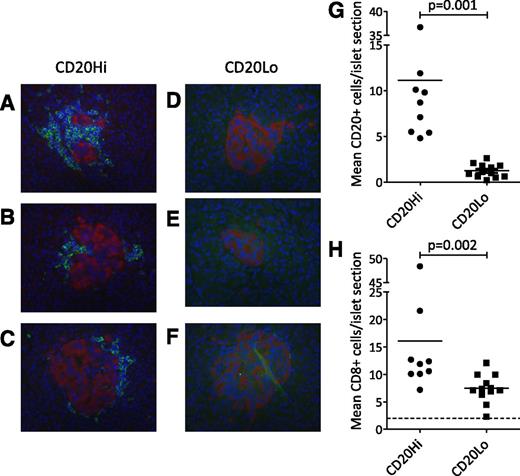 Figure 4. Immunohistological analysis of pancreas from patients with type 1 diabetes reveals heterogeneity of insulitis. Staining shows CD20+ cells in three representative islets from a single patient with abundant positivity (nPOD 6052) (A–C) and a single patient with absence of positivity (nPOD 6070) (D–F). Staining patterns correspond to hyper-immune CD20Hi and pauci-immune CD20Lo, respectively. CD20 staining was used to subdivide 21 patients into CD20Hi and CD20Lo categories by using mean CD20+ cell counts above and below 3.7 cells/islet.