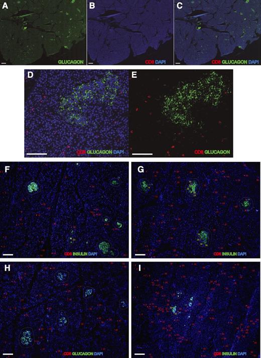Figure 1. Quantification of CD8+ T cells in pancreatic tissue sections. Representative quantification of CD8 T cells in pancreata is shown (see Research Design and Methods for details). A–E: Frozen pancreas sections from a T1D donor with <5 years of disease duration were stained for glucagon and CD8. Images were acquired using a BIOREVO BZ-9000 slide scanner system (Keyence, Osaka, Japan). Representative images of exocrine and endocrine pancreatic CD8 T cell quantification in healthy (F), Ab+ (G), T1D (H), and T2D donors (I). Numbers represent CD8 T cell quantification in the exocrine pancreas (in red), in the periphery of the islet (in blue), and in the endocrine tissue (in yellow). The contour of the islets is defined by a dashed line. Scale bars, 500 μm in A–C and 100 μm in D–I.