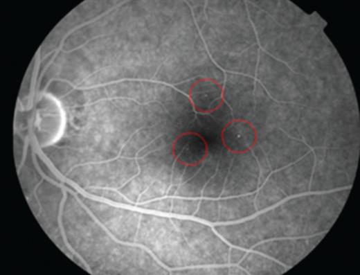 The left eye of a patient with initial diabetic retinopathy and three identified microaneurisms (red circles).