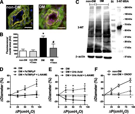 Figure 2. Representative fluorescent images of DHE staining (A) and summary data of fluorescent intensities/nuclei area (arbitrary unit [AU]) (B) in coronary arteries of non-DM (n = 4) and DM patients (n = 3). DAPI, blue; DHE fluorescence, red; autofluorescence, green (at 488 nm). Purple color indicates overlap of blue nuclei and strong DHE red fluorescence. Scale bar, 50 μm. *, DM vs. non-DM patients; #, DM vs. DM+Tiron. P < 0.05. C: Representative Western immunoblot shows 3-NT formation in coronary arterioles of non-DM and DM patients. St, molecular weight standard. 3-NT-BSA was used for positive control and anti–β-actin was used for loading variations. D and E: WSS-induced changes in diameter of coronary arterioles from patients with DM (●, n = 5) in the presence of ONOO− scavengers, FeTMPyP (n = 5) (D) or uric acid (▲, n = 5) (E) and also in the simultaneous presence of FeTMPyP or uric acid and l-NAME (♦, n = 4). F: WSS-induced changes in the diameter of coronary arterioles from non-DM patients (○, n = 5) after bolus exposure to exogenous ONOO− (10 μmol/L, △, n = 4). Data are means ± SEM. *, significant effects of various treatments. P < 0.05.