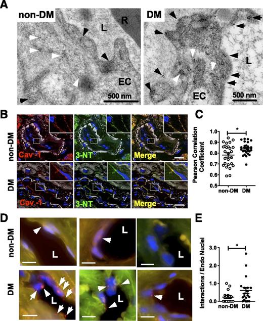 Figure 3. A: Electron micrograph illustration shows subcellular distribution of anti–3-NT immunogold particles (10 nm) in coronary arteriolar endothelium in non-DM (left) and DM patients (right). For detailed quantitative assessment of 3-NT nanogold distribution, see Table 2. Black arrowheads indicate 3-NT localization in close proximity to the luminal or abluminal plasma membrane, whereas white arrowheads point to cytosolic localization. EC, endothelium; L, vessel lumen; R, erythrocyte. B: Representative immunohistochemistry images for colocalization of Cav-1 and 3-NT in coronary arterioles of non-DM and DM patients. Blue, DAPI (nuclei); red, Cav-1; green, 3-NT; yellow, overlap of red and green signal; white, autofluorescence (at 488 nm). Scale bar, 20 µm. C: Summary data of Pearson correlation analysis for determining the degree of colocalization of Cav-1 and 3-NT. Random regions (26 and 26 from three non-DM and three DM patients) along endothelial cells were selected manually, and a scatterplot of Cav-1 and 3-NT fluorescent intensities (normalized to the background adjacent to the region of interest) was generated. ImageJ (NIH) was used to determine pixel signal intensities for each region of interest. D: Representative immunohistochemistry images of PLA for colocalization of Cav-1 and 3-NT in coronary endothelium of non-DM (top panels) and DM patients (bottom panels). E: Summary data represent PLA-positive signals obtained in five non-DM and seven DM patients. Three coronary vessels from each patient were analyzed for the number of PLA-positive interactions (shown as red blobs) around the endothelial (ENDO) nuclei (DAPI shown in blue). Green, autofluorescence (at 488 nm). White arrowheads point to PLA-positive signals. Scale bar, 15 µm. Data are means ± SEM. *, non-DM vs. DM patients. P < 0.05.