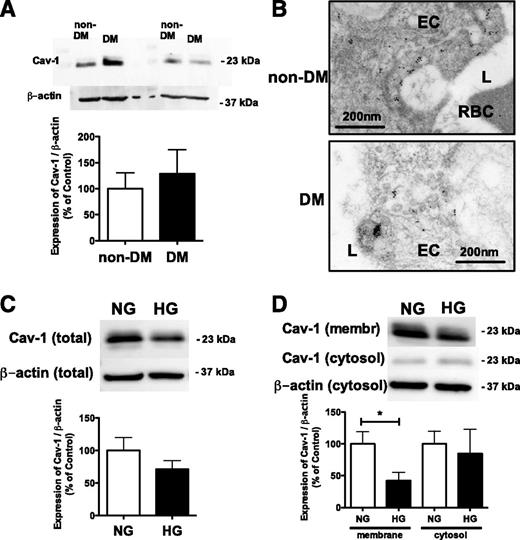 Figure 4. A: Representative Western immunoblot and summary data of densitometry analysis show Cav-1 expression in coronary arterioles of non-DM and DM patients (n = 6 non-DM and n = 6 DM). Anti–β-actin was used for normalizing loading variations. B: Electron micrograph illustration shows subcellular distribution of anti–Cav-1 immunogold particles (10 nm) in coronary arteriolar endothelium in non-DM (top) and DM (bottom) patients. For detailed quantitative assessment of Cav-1 nanogold distribution, see Table 2. EC, endothelium; L, vessel lumen; RBC, erythrocyte. Representative Western immunoblot and summary data of densitometry analysis of three independent experiments show Cav-1 expression in total lysate (C) or membrane and cytosole fractions (D) of HCAECs in the presence of normal glucose (NG; 5.5 mmol/L) or after HG (25 mmol/L) exposure. Anti–β-actin was used for normalizing loading variations. *, NG vs. HG. P < 0.05.