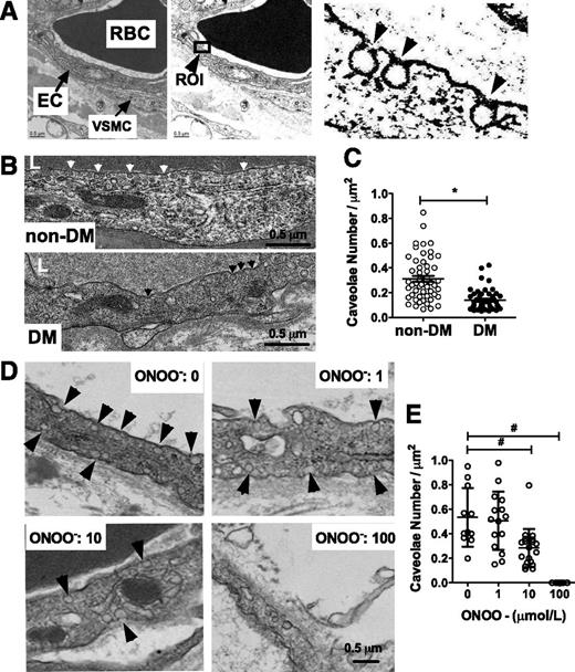 Figure 5. Electron microscopy for quantitative analysis of caveolae. A: Scheme for analysis of the electron microscopy images. Endothelial cells (ECs) were identified as those regions adjacent to erythrocytes (RBC). VSMC, vascular smooth muscle cell (left). A photo editor was used to establish a threshold gate to assist in identifying caveolae in multiple regions of interest (ROIs) (middle). Caveolae (black arrowheads) within endothelial cells were defined as apical or basal invaginations open to the surface, and membranes for analysis had to contain at least one caveolae (right). B: Representative electron micrograph illustration of the coronary endothelium in non-DM (top, white arrowheads point at caveolea) and DM patients (bottom, black arrowheads point at caveolea). Scale bar, 0.5 µm. C: Summary data show comparison of the number of endothelial membrane caveolae per µm2 in non-DM (○, data are from 53 membrane regions from three patients) and DM patients (●, data are from 46 membrane regions from three patients). Electron micrograph illustration (D) and summary data (E) demonstrate the effects of increasing concentrations (1–100 μmol/L) of exogenous ONOO− on the number of coronary endothelial caveolae. Scale bar, 0.5 µm. Black arrows point at caveolae. Data are means ± SEM. *, non-DM vs. DM patients; #, significant effect of ONOO− treatment. P < 0.05.