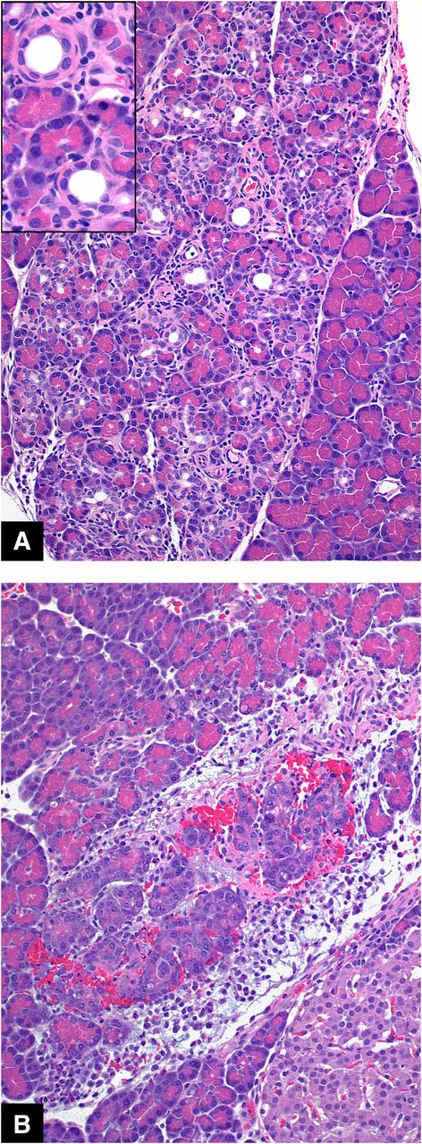 Figure 3. Pancreatic inflammation (pancreatitis) in untreated male S-D rats. A: Features of the affected lobule are acinar atrophy, mixed cell inflammation, and formation of duct-like structures (ductal metaplasia). Inset: Higher magnification demonstrates ductal metaplasia. B: Acute pancreatitis with acinar cell loss/atrophy, neutrophilic inflammation, edema, hemorrhage, and fibrin exudation. Original magnification: H-E ×20; inset ×40.