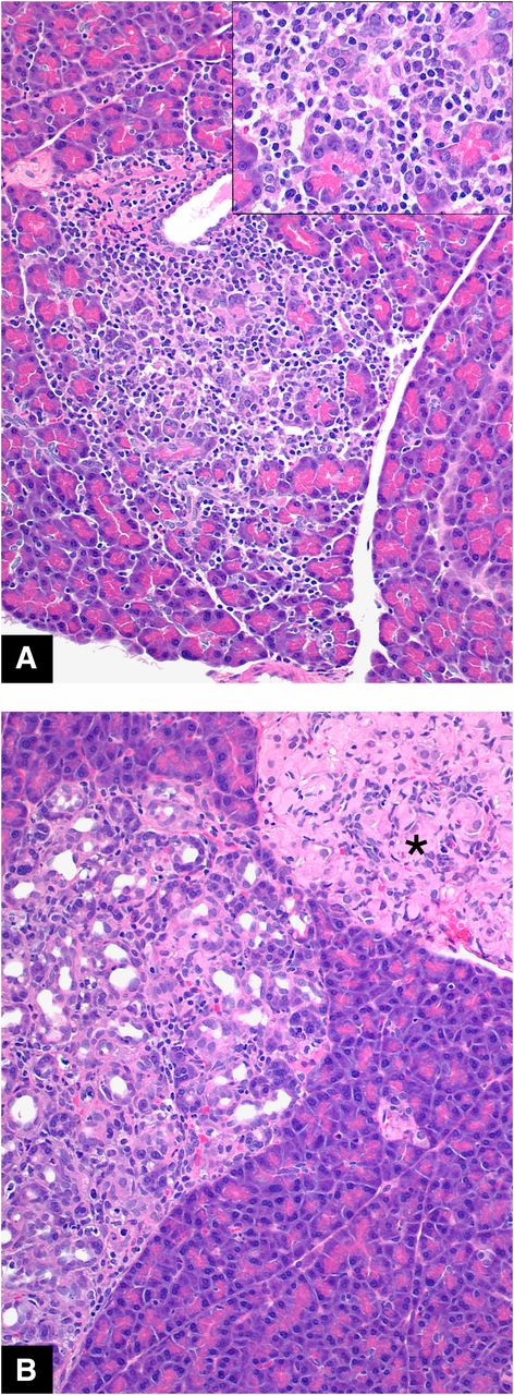 Figure 4. Pancreatic inflammation (pancreatitis) in untreated male HIP rats. A: Features of affected lobule are acinar atrophy, acinar cell loss, and inflammation (primarily mononuclear cell). Inset: Higher magnification demonstrating mononuclear cell inflammation. B: In addition to acinar atrophy and inflammation, several prominent duct-like structures are present (ductal metaplasia). Islet amyloidosis (human IAPP), characteristic of the transgenic HIP rat, is indicated by the asterisk. Original magnification: H-E ×20; inset ×40.