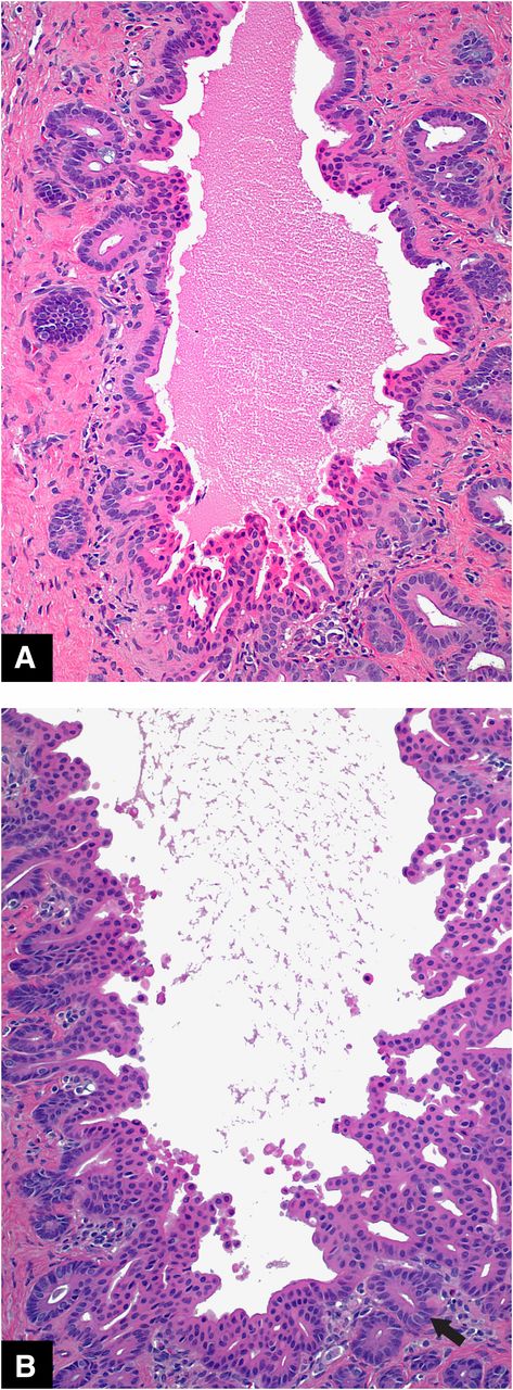 Figure 5. Common pancreatic ducts from untreated S-D rats (longitudinal sections). A and B: Normal variations of duct epithelium with epithelial stratification/pseudostratification, papillary projections, and PDGs. Cribriform epithelial pattern within the lumen (B) and PDGs are indicated by the arrow. Original magnification: H-E ×20.