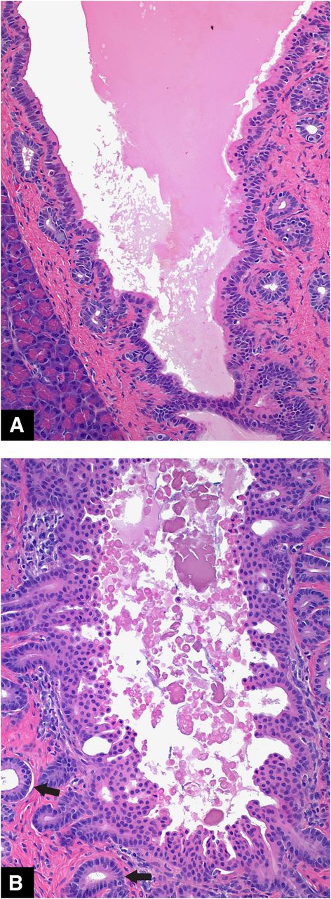 Figure 6. Common pancreatic ducts from untreated HIP rats (longitudinal sections). A and B: Normal variations of duct epithelium with epithelial stratification/pseudostratification, papillary projections, and PDGs. Cribriform epithelial pattern within the lumen (B) and PDGs are indicated by the arrows. Original magnification: H-E ×20.
