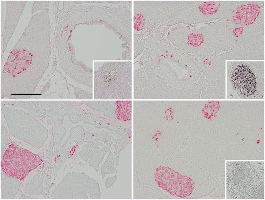 Figure 5. Fifty-two weeks’ liraglutide study in nonhuman primates. Double immunohistochemical staining for glucagon (pink) and Ki-67 (black). Male (left) and female (right) from control (upper row) or liraglutide high-dose group (lower row). Glucagon staining shows a high and variable number of α-cells in islets and a small number of single cells and small clusters of glucagon-positive cells in the acinar exocrine pancreas and associated with ducts. The inserts show Ki-67 labeling in lymph nodes in the same sections. In total, 15 of 32 monkeys had lymph nodes in these double-stained sections but none of the high-dose treated male monkeys had lymph nodes in such sections. Original magnification ×200.
