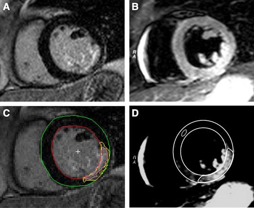 Figure 1. Examples of T2-weighted and delayed enhancement images. A delayed enhancement image was used for final infarct size analysis (A), and a T2-weighted image was used for area-at-risk analysis (B). The endocardial and the epicardial borders were manually traced in all short-axis images, and the LV myocardial mass was calculated. Papillary muscles were considered parts of the LV cavity. C: A semiautomatic approach was used to calculate the infarct size. The mean signal intensity was determined automatic in five sectors in each slice. The region with the lowest mean signal intensity was considered “remote” myocardium. A slice-specific threshold was then set as the mean of the remote sector plus 1.8 SDs. In order to take the partial volume effect into account, each pixel within the infarct region was then weighted according to the signal intensity, where the minimal detectable pixel was set as 10%, with weight shown by pink and yellow, respectively. D: The area at risk was defined as the hyperintense area on T2-weighted images. The remote myocardium was determined visually, and the signal intensity within this region was calculated by tracing a region of at least 10 pixels in the middle of the myocardial wall. The signal intensity was then adjusted to the value of the normal + 2 SDs, and the areas of hyperintensity were traced manually.