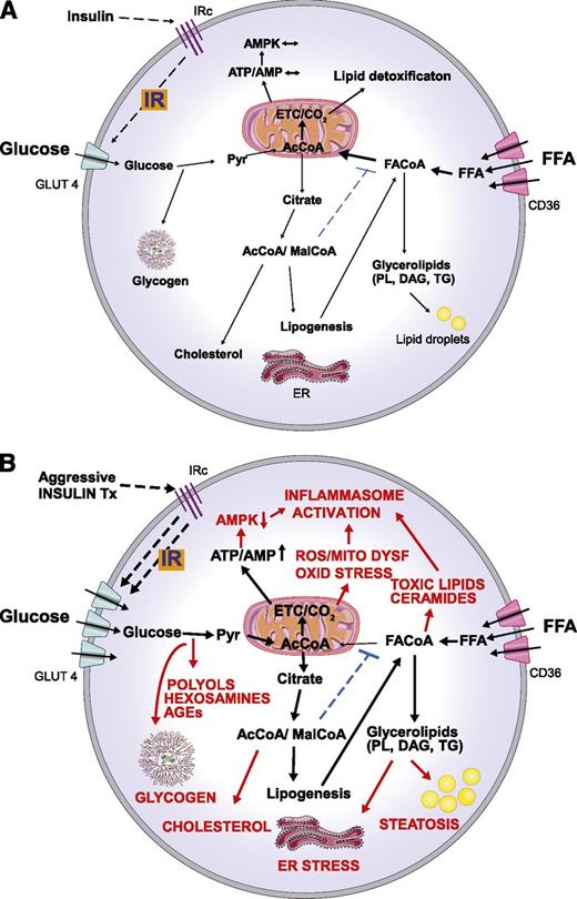 Figure 1. Hypothetical model illustrating the molecular basis of insulin-induced metabolic stress in patients with poorly controlled T2D in which both blood glucose and FFA levels are persistently elevated. Depicted here is a cell in which (A) IR protects from nutrient overload and metabolic stress by limiting glucose flux into the cell and (B) the IR protection is overridden by a high dose of exogenous insulin therapy, which promotes excess glucose uptake and glucolipotoxicity. Excess glucose supply to the mitochondria results in reducing equivalent overload of the electron transfer chain and enhanced production of ATP and ROS, resulting in oxidative damage. The resulting increased ATP/AMP ratio inhibits AMPK, which has the effect of decreasing FFA oxidation (limiting nutrient detoxification) favoring fat deposition. Enhanced glucose uptake can also result in excessive glycogen deposition and increased activities of the toxic polyol, hexosamine, and AGE formation pathways. Glucose that is metabolized via the anaplerosis pathway can also increase cytosolic acetyl-CoA (AcCoA) and malonyl-CoA (MalCoA). AcCoA and MalCoA are then available for cholesterol and fatty acid synthesis, increasing the lipid load on the cell. MalCoA also inhibits fatty acyl-CoA (FACoA) entry into the mitochondria such that FACoA is more available for synthesis of complex lipids, including glycerolipids (phospholipids, diacylglycerols, and triglycerides) and ceramides. This can result in endoplasmic reticulum stress and the accumulation of lipid droplets (steatosis). Increased ROS production, toxic lipid accumulation, and reduced AMPK activity are factors that also activate the inflammasome contributing to cardiac injury. The overall effect is nutrient overload and metabolic stress causing cell dysfunction or death and cardiac inflammation. CD36, free fatty acid transporter; DAG, diacylglycerols; ER, endoplasmic reticulum; ETC, electron transport chain; GLUT4, facilitative glucose transporter 4; IRc, insulin receptor; MITO DYSF, mitochondrial dysfunction; OXID STRESS, oxidative stress; Pyr, pyruvate; PL, phospholipids; TG, triglycerides; Tx, treatment.