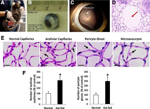 Figure 1. Marmoset eye, macula, and retinal capillary network surrounding macular area and acellular capillaries, pericyte loss, and microaneurysms in gal-fed marmoset. A: Marmoset is an unusually small primate. B: An adult marmoset eyeball is ∼13 mm in diameter. C: Marmoset macula (white arrow) is present at an ∼2.5 disc diameter distance from the optic disc. D: A prominent foveal avascular zone is located in the macula (red arrow). Note that the relative size and location of macula with respect to the optic disc in the marmoset retina are strikingly similar to those of the human macula. E: Effect of hyperhexosemia on retinal vascular lesions characteristic of DR. Representative images of retinal capillary network show increased number of acellular capillaries and pericyte loss in the retinas of gal-fed marmosets compared with those of control marmosets. Incipient microaneurysms were detected in the gal-fed marmosets. Magnification bar: 20 μmol/L. F: Graphical illustrations showing significant increase in the number of acellular capillaries (left) and pericyte ghosts (right) in the retinas of gal-fed marmosets compared with those of control marmosets. *P < 0.05.