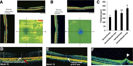 Figure 4. Representative retinal OCT scans of a gal-fed marmoset and a normal marmoset and pathological changes in the retinas of gal-fed marmosets. Significant thickening of the foveal and the juxtafoveal area, indicative of intraretinal fluid accumulation, was observed in retinas of gal-fed marmosets. Color heat images show increased foveal thickness in retinas of a gal-fed marmoset (A) compared with the foveal thickness of a normal marmoset (B). C: Graphical illustration showing macular and foveal thickness in retinas of control and galactose-fed marmosets. *P < 0.03, **P < 0.02. D–F: Representative images of the macular area showing alterations in RPE, photoreceptor layer, and an incipient cystoid retinal edema in gal-fed marmosets. D: Fluid accumulation in the choroid (red arrow) and discontinuation at the photoreceptor layer (white arrow) representing early stages of edematous retina were observed in a gal-fed marmoset. E: Retinal thickening was accompanied by changes in RPE and retinal photoreceptor layer starting at the fifteenth month of galactose feeding. F: An OCT scan of the central retina showing a hyporeflective space just above the RPE level indicative of intraretinal fluid accumulation (arrowhead).