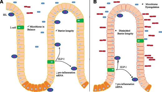 Figure 1. Schematic of the intestinal mucosa showing the normal state with intact GLP-1 signaling (A) and the consequences of impaired GLP-1 action on IELs (depicted as blue cells with purple nuclei) (B). GLP-1 stimulation of IELs promotes barrier function and normal microbial interaction and mutes inflammation. Loss of this activity has the potential to cause abnormalities in mucosal function.