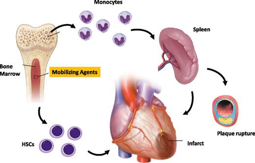 Figure 1. Following MI, a chemokine gradient promotes the liberation of stem cells and mature MNCs from BM. Stem cells and MNCs favor the healing of infarcted myocardium through the stimulation of angiogenesis, cardiomyogenesis, and inhibition of apoptosis. On the other hand, the population of monocytes comprises M1 inflammatory and M2 resolutive cells endowed of opposite properties. Monocytes undergo maturation in the spleen where they acquire proinflammatory and proatherogenic properties, which may favor adverse events such as plaque progression or rupture and restenosis. Administration of exogenous chemokines potentiates this endogenous response. In diabetes, a bias in hematopoiesis shifts the mobilization response toward the liberation of proinflammatory cells.