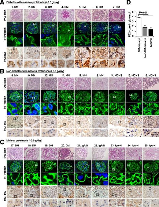 Figure 1. Autophagy insufficiency in podocytes of patients with diabetes and massive proteinuria. A–C: Representative pictures of PAS staining, immunofluorescent (IF) assays of podocin protein, and immunohistochemistry (IHC) for p62, a marker of autophagy insufficiency, in kidney biopsy specimens from patients with diabetic nephropathy (DM) and massive proteinuria (patients 1–7) or minimal proteinuria (patients 17–20), membranous nephropathy (MN) with reversible massive proteinuria (patients 8–13), minimal change nephrotic syndrome (MCNS) (patients 14–16), and IgA nephropathy (IgA-N) with minimal proteinuria (patients 21–25). Massive proteinuria was defined as >3.5 g/day and minimal proteinuria as <0.5 g/day. Original magnifications: ×400 for PAS stain and IHC of p62 and ×600 for IF of podocin. D: Semiquantitative measurement of p62 intensity in the glomeruli in each group. All results are presented as mean ± SEM and compared by ANOVA and a subsequent Tukey test, with P < 0.05 considered statistically significant. The white and black boxes indicate the areas for the magnified pictures.