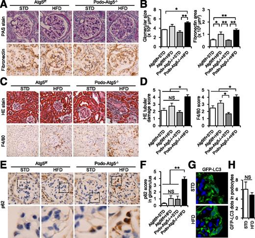 Figure 4. Exacerbation of proteinuria-related tubulointerstitial lesions in HFD-fed, podocyte-specific autophagy-deficient mice. A: Representative pictures of PAS staining and immunohistochemical expression of fibronectin in glomeruli of four groups of mice. Original magnification ×400. B: Quantitative analysis of glomerular size and fibronectin-positive areas in glomeruli. C: Quantitative evaluation of tubulointerstitial lesions by H-E staining and immunohistochemical analysis of F4/80. Original magnification ×200. D: Tubular damage scores by H-E staining and F4/80-positive scores. E: Representative pictures of immunohistochemical assays for p62. Original magnification ×400. F: Quantitation of the numbers of p62-positive cells in the glomeruli of the four groups of mice. The black boxes indicate the areas for the magnified pictures. G and H: GFP-LC3 dot analysis of GFP-LC3 transgenic mice fed an STD or HFD for 32 weeks. Representative pictures of the glomeruli from GFP-LC3 transgenic mice fed the indicated diet (G) and quantitation of numbers of GFP dots in the glomeruli (H) (n = 4). Original magnification ×1,000. All values are presented as mean ± SEM, with statistical significance determined by ANOVA and subsequent Tukey tests for multiple comparisons and by Student t tests for pairwise comparisons. *P < 0.05 and **P < 0.01 vs. the indicated groups. NS, no significance.