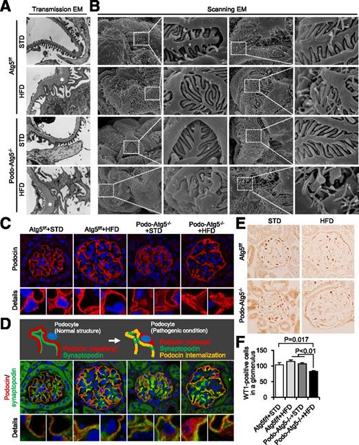 Figure 5. Podocyte dysfunction and loss in HFD-fed, podocyte-specific autophagy-deficient mice. Representative transmission (A) and scanning (B) electron microscopy (EM) of glomeruli from Atg5f/f and Atg5−/− mice fed an STD or HFD for 32 weeks. The asterisks indicate thickening of the glomerular basement membrane. Original magnifications: ×10,000 for transmission electron microscopy and ×8,000 for scanning electron microscopy. The white boxes indicate the areas for the magnified pictures. C: Immunofluorescent determination of podocin expression in glomeruli from the four groups of mice. Original magnification ×1,000. D: Double immunofluorescent determination of podocin and synaptopodin in glomeruli from the four groups of mice. Original magnification ×1,000. The red- and green-colored lines represent podocin and synaptopodin, respectively. Under normal conditions, both proteins are visible as a capillary pattern. Once podocyte damage occurs, podocin is internalized, making yellow lines and red-colored dots in cytosol. E: Representative pictures of WT1 stain in glomeruli of the four groups of mice. Original magnification ×400. F: Quantitation of WT1-positive podocytes in glomeruli. All values are presented as mean ± SEM. Differences were determined by ANOVA and a subsequent Tukey test.