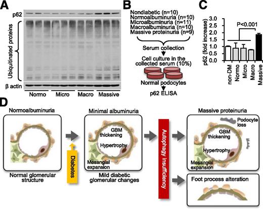Figure 8. Autophagy-lysosome dysfunction and apoptosis in cultured podocytes stimulated with sera from patients with diabetes and massive proteinuria. A: Representative Western blot analyses of p62, ubiquitinated proteins, and β-actin in cultured podocytes incubated with sera from patients with type 2 diabetes and normo- (n = 3), micro- (n = 3), macro- (n = 2), and massive albuminuria (n = 3). B: Protocol of the cell culture experiment. Cultured normal podocytes were incubated with the sera from subjects without diabetes (n = 10), and patients with diabetes and normo- (n = 10), micro- (n = 11), macro- (n = 10), and massive albuminuria (n = 9). The collected cell lysates were analyzed by ELISA for expression of p62 protein. C: Result of p62 ELISA. All results are presented as mean ± SEM and compared by ANOVA and a subsequent Tukey test, with P < 0.05 considered statistically significant. D: Hypothetic schema of the current study. Diabetic conditions alone result in mild glomerular lesions with minimal proteinuria. During disease development, however, the combination of insufficient podocyte autophagy and diabetes results in podocyte loss and foot process alteration with lysosome dysfunction, which is associated with the pathogenesis of massive proteinuria. GBM, glomerular basement membrane; non-DM, nondiabetic.