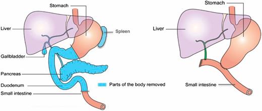 Figure 1. Illustration of the changed anatomy after total pancreatectomy operation. Left: The anatomy before operation, with the light blue–colored organs indicating the organs being removed during surgery. Right: The anatomy after surgery.