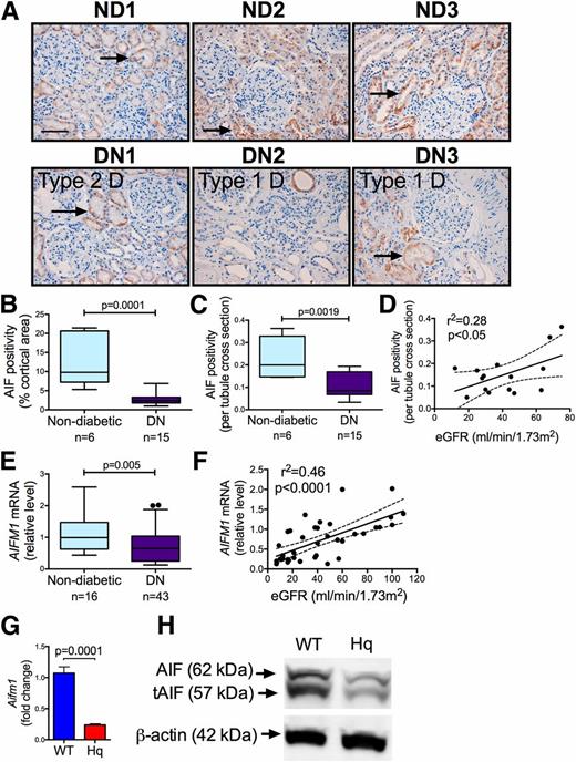 Figure 1. AIF is present in the human kidney and is decreased in patients with CKD. A: AIF was localized predominantly to the renal tubules in human renal biopsy samples obtained from individuals without diabetes (top panels, nondiabetic [ND1, ND2, ND3]) and from patients with diabetes and DN (DN1, DN2, DN3; bottom panels: left, type 2 diabetes; middle and right, type 1 diabetes). Original magnification ×200. Scale bar = 50 μm. Arrows indicate tubular AIF staining. B: Quantitation of AIF protein expression (percent cortical area) in patients with diabetes (n = 15) compared with individuals with normal glucose tolerance (n = 6), P = 0.0001. The box represents the interquartile range, whiskers represent range, and median is shown by the cross bar. C: Quantitation of AIF protein in renal tubules (per tubule cross section) in patients with diabetes (n = 15) compared with individuals with normal glucose tolerance (n = 6), P = 0.0019. D: Correlation between AIF (per tubule cross section) and eGFR, r2 = 0.28, P = 0.042, n = 15 (data shown comprise n = 2 control subjects and n = 14 patients with diabetes). E: AIFM1 mRNA expression by qPCR in renal cortex obtained from patients with DN (n = 43) and nondiabetic control subjects (n = 16), P = 0.005. F: Correlation between AIFM1 gene expression and eGFR, r2 = 0.46, P < 0.001, n = 38 (data comprise patients with DN only). G: Aifm1 expression (encoding for AIF) in kidneys from Hq mice (n = 15) compared with WT control mice (n = 13). H: Representative immunoblots demonstrating mature (62 kDa) and truncated AIF (tAIF; 57 kDa) protein with β-actin loading control in kidney cortical homogenates from WT and Aifm1Hq/Y (Hq) mice.