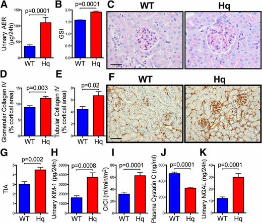 Figure 2. Knockdown of AIF recapitulates nephropathy. Urinary AER (A), GSI (B), photomicrographs of PAS-stained renal cortex (original magnification ×400, scale bar = 25 μm) (C), quantitation of collagen IV deposition within glomeruli (D), quantitation of collagen IV deposition within the tubulointerstitial compartment (E), photomicrographs of collagen IV deposition by immunohistochemistry (original magnification ×200, scale bar = 50 μm) (F), tubulointerstitial area (TIA) (G), urinary excretion of KIM-1 (H), creatinine clearance (CrCl) (I), and plasma cystatin C level (J). K: Urinary excretion of NGAL. Data are reported as the mean ± SEM, n = 5–15 mice/group. Aifm1Hq/Y, Hq.