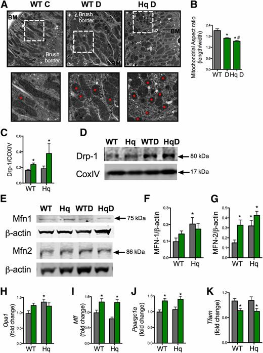 Figure 5. Diabetes superimposition on Aifm1 knockdown remodels the mitochondrial network. A: Electron micrographs of renal PTECs showing mitochondrial morphology in WT control (left), WT diabetic (middle), and Aifm1Hq/Y (Hq) diabetic (right) mice. Red dots indicate fragmented mitochondria. BM, basement membrane. Top row: Original magnification ×15,000; scale bar = 1 μm. Bottom row is the area bounded by the white boxes in the top row enlarged. B: Mitochondrial aspect ratio (length/width). The gray bar represents control mice, and the green bars represent mice with diabetes (D). Data are reported as the mean ± SEM, n = 5–6 images/mouse (with up to 143 mitochondria scored in each image), n = 3 mice/group. C: Quantitation of Western blot of Drp-1 in mitochondrial isolates, n = 4 mice/group. COX IV was used as a loading control. D: Representative Western blot of Drp-1 (80 kDa) in mitochondria with COX IV loading control, n = 4 mice/group. E: Representative Western blots of MFN1 and MFN2 with corresponding β-actin loading controls beneath. F: Quantitation of MFN1 Western blot relative to β-actin, n = 6–8 mice/group. G: Quantitation of MFN2 Western blots relative to β-actin, n = 6–8 mice/group. qPCR analysis of genes involved in mitochondrial fusion, fission, and biogenesis Opa1 (H); mitochondrial fission factor (Mff) (I); Ppargc1α (J); and Tfam renal cortex (K). n = 9–15 mice/group. *P < 0.05 compared with WT control mice, #P < 0.01 compared with diabetic mice.