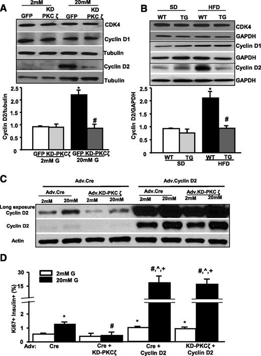 Figure 6. Glucose-mediated and HFD-induced upregulation of cyclin-D2 is impaired by inhibiting PKCζ activity. Representative image of a Western blot showing the expression of cyclin-D1, cyclin-D2, and CDK4 in protein extracts from INS-1 cells transduced with Adv.GFP or Adv.KD-PKCζ and treated with 2 or 20 mmol/L glucose (G) for 24 h (A) or islets from SD- or HFD-fed WT and RIP-KD-PKCζ TG mice for 7 days (B) and the densitometric quantitation of cyclin-D2 in n = 4 experiments/mice. Results are means ± SEM. *P < 0.05 vs. 2 mmol/L Adv.GFP or SD mice; #P < 0.05 vs. 20 mmol/L Adv.GFP or HFD-WT mice. C: Representative image of a Western blot showing the expression of cyclin-D2 in mouse islet cells transduced with Adv.Cre (control), Adv.KD-PKCζ, and Adv.Cyclin-D2 at a total MOI of 200 and treated with 2 or 20 mmol/L glucose for 24 h. This Western blot was performed three times with identical results. D: β-Cell proliferation in mouse islet cell cultures transduced with the adenoviruses indicated in C, incubated with 2 or 20 mmol/L glucose for 24 h and assessed by insulin, Ki67, and DAPI immunostaining. Results are means ± SEM. *P < 0.05 vs. 2 mmol/L Adv.LacZ; #P < 0.05 vs. 20 mmol/L Adv.LacZ; ^P < 0.05 vs. 20 mmol/L Adv.KD-PKCζ; +P < 0.0.5 vs. 2 mmol/L Adv.Cyclin-D2 or Adv.Cyclin-D2 + Adv.KD-PKCζ.