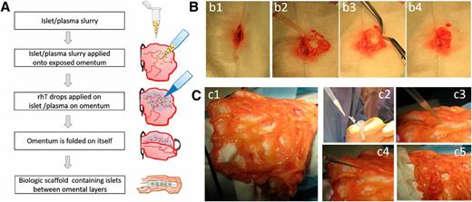 Figure 1. Intraomental islet implantation within a biologic scaffold. A: Schematic diagram of the transplant procedure. B: Procedure in rat. C: Procedure in NHP. After midline laparotomy (b1), the omentum is gently exteriorized and opened (b2 and c1). The islet graft, resuspended in autologous plasma (c2), is gently distributed onto the omentum (b3 and c3). Recombinant human thrombin is added onto the islets on the omental surface to induce gel formation (c4), and then the omentum is folded to increase the contact of the graft to the vascularized omentum (b4 and c5). Nonresorbable stitches were placed on the far outer margins of the graft in the NHP (c5) for easier identification of the graft area at the time of graft removal.