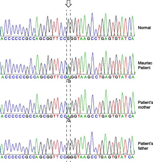 Figure 2. The G → A heterozygous mutation in PHKG2 in the patient with Mauriac syndrome and his mother. The figure shows the tracing of the nucleotide sequence surrounding the PHKG2 G → A mutation in DNA samples from the Mauriac patient and his mother, as well as a tracing of the normal sequence from his father’s DNA and a tracing from 1 of 231 other Caucasian patients with type 1 diabetes whose glycemic control ranged from extremely poor to excellent and did not have an enlarged liver, and who all had normal PHKG2 exon sequences.