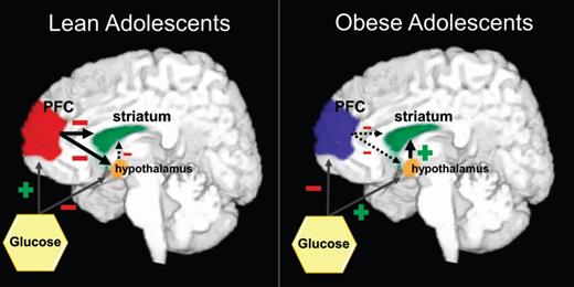 Schematic diagram to illustrate altered regional cerebral blood flow response to glucose in lean and obese adolescents.
