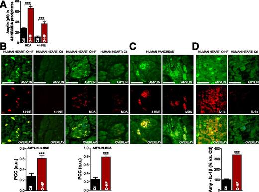 Figure 2. Failing hearts from obese patients display amylin-4-HNE and amylin-MDA adducts and increased IL-1β synthesis. A: 4-HNE and MDA were immunoprecipitated from heart homogenates. The level of amylin in the fractions enriched in 4-HNE and MDA was then quantified by ELISA. Dual-immunofluorescence staining of amylin (green) and 4-HNE or MDA (red) in the heart (B) and pancreas (C) of patients with O-HF (B), patients with type 2 diabetes (C), and Ctl subjects without diabetes (Ctl; B). Bar graphs in B display the mean pixel-by-pixel covariance in amylin and 4-HNE or MDA staining (Pearson’s correlation coefficient [PCC]) in hearts from patients with O-HF vs. Ctl subjects. Scale bars, 20 μm. Ten sections per sample from n = 4 individuals in each group were investigated. D: Immunofluorescence staining of amylin (green) and IL-1β (red) in the heart specimens from O-HF patients and Ctl subjects. Bar graphs show the number of myocytes that are positive for both amylin and IL-1β in a 134 × 134 μm area in heart sections from patients with O-HF vs. Ctl subjects. Scale bars, 20 μm. Ten sections per sample from n = 4 individuals in each group were investigated. Data are presented as the mean ± SE. ***P < 0.001. a.u., arbitrary units.