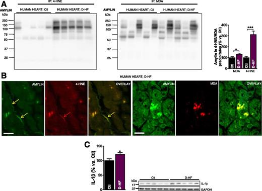 Figure 3. Failing hearts from patients with type 2 diabetes display amylin-4-HNE and amylin-MDA adducts and increased IL-1β synthesis. A: Western blot analysis of enriched 4-HNE and MDA fractions immunoprecipitated from the left ventricles of patients with D-HF vs. nondiabetic Ctl subjects. B: First three images show dual-immunofluorescence staining of amylin (green) and 4-HNE (red) on transverse sections from left ventricle tissue of patients with D-HF vs. nondiabetic Ctl subjects. Arrows indicate amylin incorporation within the sarcolemma and the subsequent formation of adducts with 4-HNE. The next three images are cross sections of cardiac tissue showing the formation of amylin-MDA adducts within cardiac myocytes. Scale bars, 20 μm. C: Western blot analysis of IL-1β in left ventricle tissue of patients with D-HF vs. nondiabetic Ctl subjects. A representative blot from two independent experiments is shown. Data are presented as the mean ± SE. *P < 0.05; ***P < 0.001.