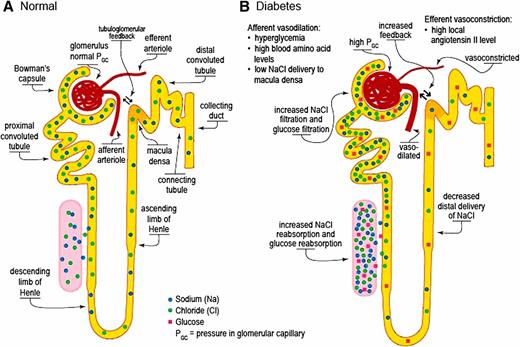 Figure 1. Glomerular structural and functional relationships as determinants of GFR. In the study by Ruggenenti et al. (17) of participants with type 2 diabetes and obesity, weight loss by calorie restriction lowered systemic blood pressure, blood glucose, and GFR. This may be interpreted as a decrease in glomerular hyperfiltration and, inferentially, intraglomerular hypertension by both decreasing transmitted blood pressure and modulating tubuloglomerular feedback. A: Normal glomerulus. The balance between vasodilation and vasoconstriction in the afferent (upstream) and efferent (downstream) arterioles determines intraglomerular pressure, a major regulator of GFR. Distal tubular delivery of solute, particularly sodium chloride, at the macula densa regulates afferent arteriolar tone via tubuloglomerular feedback. B: Glomerulus in diabetes. The afferent arteriole opens in response to vasodilatory factors such as hyperglycemia and high blood levels of amino acids. Because of a high filtered load of glucose, reabsorption of glucose and sodium chloride is increased in the proximal tubule. The afferent arteriole also dilates in response to decreased delivery of sodium chloride to the distal tubular macula densa via tubuloglomerular feedback. The efferent arteriole vasoconstricts in response to high local production of angiotensin II. Overall, the balance shifts to glomerular hyperfiltration as a result of high intraglomerular pressure from afferent arteriolar vasodilation and efferent vasoconstriction.