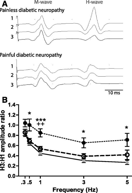 Figure 4. Tibial H-reflex RDD is attenuated in patients with painful diabetic neuropathy. A: Representative electromyogram traces showing M and H waves in response to three consecutive stimulations at 1-Hz frequency in a patient with painless (upper triplicate) and painful (lower triplicate) diabetic neuropathy. Note the decline of the H-wave amplitude in the traces from the patient with painless neuropathy that illustrates RDD. B: RDD, expressed as H3-to-H1 ratio, at ascending stimulation frequencies in control subjects (n = 15: filled gray circles, solid line) and patients with painless (n = 14: open circles, large dashed line) and painful (n = 13: filled black circles, small dashed line) diabetic neuropathy. Data are group mean ± SEM. Statistically significant differences were identified with the Kruskal-Wallis test followed by Dunn post hoc test for multiple comparisons: *P < 0.05, ***P < 0.001 for painful diabetic neuropathy against control group; ++P < 0.01 for painful diabetic neuropathy against painless diabetic neuropathy.