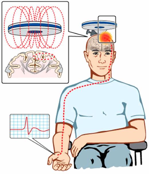 Figure 1. TMS excites a network of neurons in the underlying motor cortex, with MEPs recorded over the contralateral APB muscle. The motor cortex is preferentially stimulated when the current flows in a posterior-to-anterior direction within the motor cortex. (Reprinted with permission from Vucic et al. [28]).