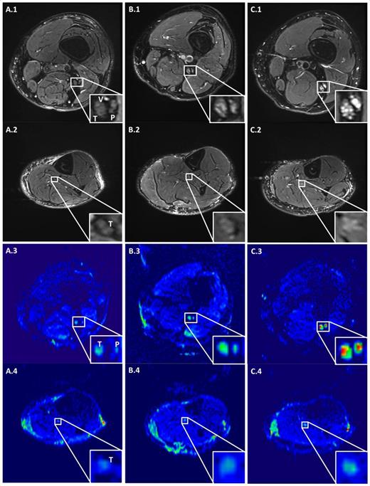 Figure 1. Axial MRIs (TR = 3,280 ms; TE = 63 ms) (rows 1 and 2) and DTI trace images (rows 3 and 4) of the thigh (rows 1 and 3) and the shin (rows 2 and 4), demonstrating the tibial (T) and peroneal (P) nerves of an HC (A), a patient with diabetes but nDPN (B), and a patient with diabetes and sDPN (C). In A.1, a small blood vessel (V) is seen close to the nerves. A color map has been applied to increase visual contrast in the DTI trace images. The MRIs indicate enlargement and signal hyperintensity in the nerves of patients with sDPN (C); the difference is most pronounced for the sciatic nerve (C.1 and C.3).