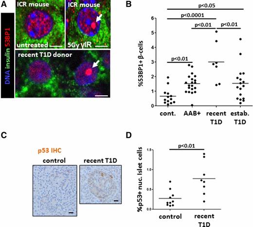 Figure 1. DDR in β-cells of patients with recently diagnosed T1D. A: Immunofluorescent staining of 53BP1 in β-cells in vivo. The top panel shows the pattern of nuclear 53BP1 in β-cells (stained for insulin) of wild-type mice, untreated or 8 h after sublethal γ-irradiation (γIR). Note the typical accumulation of a large, single nuclear focus of 53BP1 in irradiated mice (arrow). The bottom panel shows two adjacent β-cells from patients with recently diagnosed T1D, with the normal or DNA damage typical pattern of nuclear 53BP1 (arrow). Scale bars = 2 μm. B: The fraction of β-cells with activated 53BP1 in healthy donors (cont.) (n = 12), people at risk for T1D (AAB+, n = 20), patients with recently diagnosed T1D (n = 7), and patients with established T1D (n = 18). Each dot represents an individual person. C: Representative images from immunostaining for p53 in islets of health donors and patients recently diagnosed with T1D. Nuclear accumulation of signal signifies p53 activation. Scale bars = 20 μm. D: Quantification of nuclear (nuc.) p53 in islets from healthy donors (n = 10) and patients with recently diagnosed T1D (n = 7). Each dot represents an individual person. IHC, immunohistochemistry.