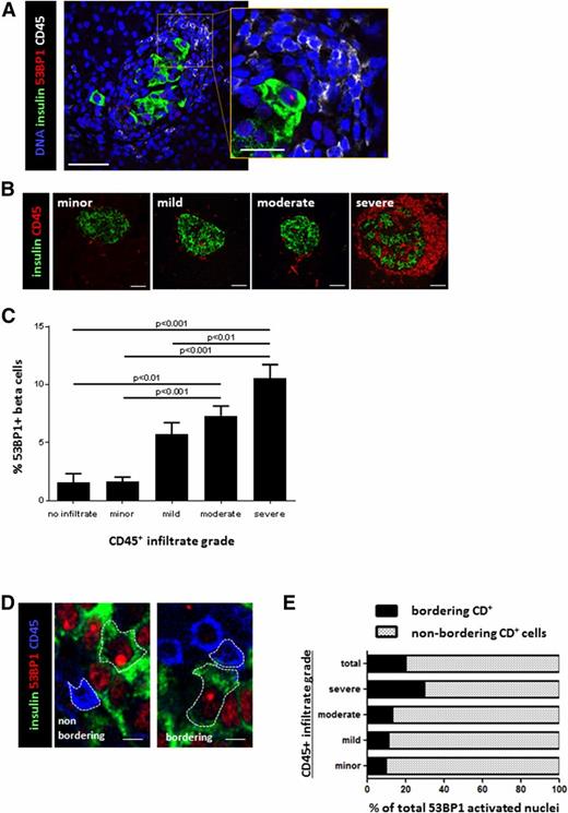Figure 2. Association of human β-cell DNA damage with islet immune infiltration. A: Costaining for β-cell DNA damage and immune infiltration in a patient with recently diagnosed T1D. A β-cell (stained for insulin) with a 53BP1 nuclear focus is surrounded by a mass of small cells with compact nuclei that stained positive for the pan-leukocyte marker CD45 (inset). Scale bar = 10 μm, scale bar for inset = 3 μm. B: Classification of islets from patients with recently diagnosed T1D according to the extent of inflammatory infiltrate. Immunofluorescent staining for β-cells (insulin) and immune cells (CD45). The degree of infiltrate is determined by both the number of CD45 cells surrounding the islet and their level of islet penetrance. Scale bars = 10 μm. C: Scores of 53BP1 foci in islets from patients with recently diagnosed T1D according to the islet infiltration score. Shown are combined results from all recently diagnosed T1D samples that had insulin staining. D: High-magnification images demonstrating 53BP1-positive β-cells (insulin [green cytoplasm] and 53BP1 [red nuclear focus]) that are immediately adjacent to leukocytes (CD45) or are physically separated from such cells. Scale bars = 5 μm. E: Quantification of immunofluorescence images as those in D, showing the distribution of β-cells with activated 53BP1 according to proximity to CD45+ cells (bordering and nonbordering).
