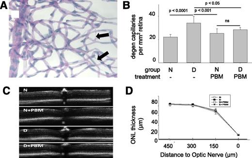 Figure 1. Diabetes (D) of 8 months’ duration significantly increased the number of degenerate (acellular) capillaries in the retinal vasculature compared with that in nondiabetic (N) mice, and daily application of PBM at 670 nm for 4 min/day to diabetic mice for the 8 months significantly inhibited the retinal capillary degeneration. A: Representative micrograph of the isolated retinal microvessels from a diabetic mouse indicating degenerate capillaries (arrows). B: Summary of numbers of degenerate (degen) retinal capillaries in the various groups. Optical coherence microscopy of mouse retinas (C) and graphical summary of thickness of the outer nuclear layer (ONL; D) in the experimental groups at 8 months of diabetes (10 months of age). n = 7/group. Data expressed as mean ± SD.