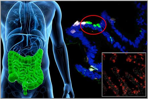 Figure 6. Enteroendocrine cell conversion. Foxo1 inhibition leads to the generation of β-like–cells in the intestine, likely arising from the conversion of either serotonin-producing or endocrine progenitor cells. The main picture shows human-induced pluripotent stem–derived gut organoid cultures after treatment with a dominant-negative Foxo1. White fluorescence corresponds to serotonin, green fluorescence to insulin immunohistochemistry. The inset shows mouse intestinal cells converted into insulin-producing cells (red) after genetic knockout of Foxo1. Blue corresponds to DAPI nuclear staining.