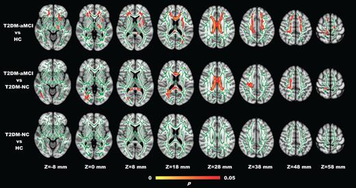 Voxel-wise differences in fractional anisotropy metrics between diabetes groups (T2DM) with either amnesic MCI (aMCI) or normal cognition (NC) and healthy control (HC) subjects. Red-yellow regions represent white matter regions with decreased fractional anisotropy in T2DM-aMCI individuals.