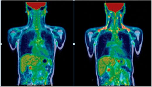 Figure 2. PET-MRI after cold exposure of patient 1 before and after melatonin supplementation. Note the increase in FDG uptake in the supraclavicular and cervical areas.