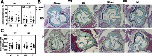 Figure 4. Neither diabetes nor MI alters lesion size. Female Ldlr−/−;GpTg mice were fed a high-fat diet with 1.25% cholesterol for 12 weeks to initiate lesion formation, switched to chow, and lethally irradiated and transplanted with either WT or LysM-mediated KO bone marrow and allowed to recover for 5 weeks before injection with LCMV to induce diabetes (D) or saline (nondiabetic [ND]). Two weeks post–LCMV injection, mice were subjected to permanent ligation of the left anterior descending coronary artery (experimental MI) or a sham surgery and maintained for an additional 3.5 weeks. Mice were maintained on a low-fat semipurified diet from the onset of diabetes. A: Aortic atherosclerosis en face visualized with the lipophilic stain Sudan IV. Quantification of aortic atherosclerosis (n = 9–13). B: Example of cross sections from the aortic sinus stained with Movat pentachrome. C: Quantification of the total lesion size in the aortic sinus. Arrows indicate necrotic cores. N = 14–24. No statistical differences observed, three-way ANOVA (WT vs. KO, nondiabetic vs. diabetic, sham vs. MI as the parameters, or the interaction between these) followed by Sidak multiple comparisons tests comparing groups that differ by one parameter.