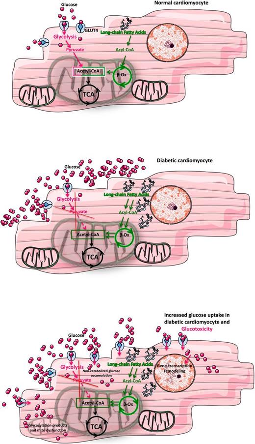 Figure 1. Metabolic competition between glucose and fatty acids in a normal cardiomyocyte, a diabetic cardiomyocyte, and a diabetic cardiomyocyte with enhanced glucose uptake. Top: In normal conditions, cardiomyocytes are able to use both fatty acids (green) and glucose (pink) as energy substrates, with a preference for fatty acids: acetyl-CoA molecules entering the mitochondrial tricarboxylic acid cycle (TCA, also known as Krebs cycle) derive from glycolysis and from fatty acid β-oxidation (β-Ox); in the β-Ox processes, long-chain acyl-CoA molecules—the main components of long fatty acids—are broken to acetyl-CoA molecules. Middle: In diabetic conditions, the excessive availability of fatty acids, mainly due to an impaired insulin signaling, engulfs the catabolic machinery, making cardiomyocytes unable to oxidize glucose. Bottom: The augmented glucose uptake induces intracellular accumulation of noncatabolized glucose, inducing glucotoxicity; furthermore, increased glucose levels can affect mitochondrial function by direct posttranslational modifications of the protein pool and/or by inducing a maladaptive gene transcription program.