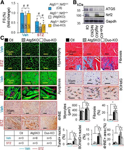 Figure 5. The impact of Nrf2KO on CR-Atg5KO–exaggerated cardiomyopathy associated with STZ-induced diabetes in mice. T1D in littermates of adult female MerCreMer+ Ctl and MerCreMer+::Atg5fl/fl (CR-Atg5KO) mice on a C57BL/6J genetic background after tamoxifen induction was induced by i.p. injection of STZ for 9 months, and T1D-induced cardiomyopathy was assessed as described in research design and methods. A: Cardiac function. *P < 0.05 vs. vehicle (Veh) Ctl in the same groups; #P < 0.05 between indicated groups. B: Tamoxifen-induced CR-Atg5KO is confirmed by Western blot analysis with use of whole LV tissue lysates at the experimental end point. C: Cardiac remodeling, apoptosis, and oxidative stress. Cardiomyocyte sizes and cardiac fibrosis, apoptosis, and oxidative stress were assessed in LVs of MerCreMer+ Ctl, MerCreMer+::Atg5fl/fl (Atg5KO), and MerCreMer+::Atg5fl/fl::Nrf2KO (Duo-KO) mice after tamoxifen induction at 9 months after onset of diabetes. Animal numbers of each group are shown in the inserted table. *P < 0.05 between indicated groups.