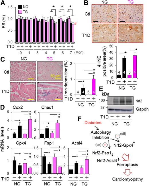 Figure 8. Nrf2-operated myocardial anti- and proferroptotic signaling in type 1 diabetic mice. T1D in adult female NG and TG mice was induced by i.p. injection of STZ as described in research design and methods. Animal numbers of each group are shown in Supplementary Fig. 22C. A: Cardiac function. Cardiac function was monitored monthly. FS (%) in fold changes. FS (%) of vehicle-treated NG and TG groups are set as onefold. *P < 0.05 between indicate groups; #P < 0.05 vs. STZ NG group at 7 months. B: Myocardial 4HNE staining at 7 months after onset of T1D. C: Myocardia iron staining at 7 months after onset of T1D. n = 3. *P < 0.05 between indicated groups. D: The effect of CR-Nrf2 overexpression on T1D-induced ferroptotic signaling. T1D in adult male NG and TG mice was induced by i.p. injection of STZ for 6 months, and myocardial expression of ferroptotic signaling genes was assessed by qPCR analysis (n = 4). *P < 0.05 between indicated groups. E: Western blot analysis of myocardial Nrf2 expression in NG and TG mice at 6 months after onset of diabetes. The results are representatives of four separated experiments. LVs of adult male NG and TG mice at 6 months after onset of diabetes were harvested for qPCR (D) and Western blot analyses (E). F: A working hypothesis. Diabetes over time impairs myocardial autophagy, which in turn inactivates Nrf2-operated antioxidant defense, such as GPX4 expression, while intensifying an Nrf2-driven pathological gene program, such as upregulation of ACSL4 to promote lipid peroxidation for ferroptosis, thereby promoting the progression of diabetic cardiomyopathy.