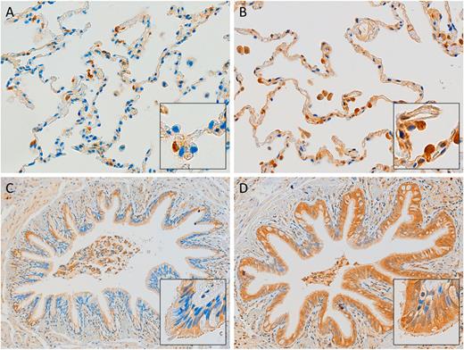 Figure 1. IHC of ACE2 protein expression in patients with and without diabetes. Representative images of ACE2 IHC staining showing positive signal in alveolar tissue of a subject without diabetes (A), alveolar tissue of a subject with diabetes (B), bronchial tissue of a subject without diabetes (C), and bronchial tissue of a subject with diabetes (D). Original magnification ×400. Insets are a magnification of a selected area.