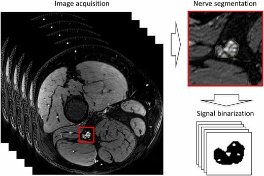 Figure 1. Nerve segmentation and binarization of lesions. Multislice segmentation of the sciatic nerve, binarization of nerve lesions, and statistical analysis of lesion load and vital nerve tissue.
