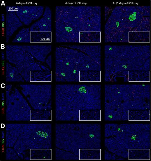 Figure 1. Double immunostaining for insulin (INS; green) in combination with CD68+ (A), CD45+ (B), CD8+ (C), and CD20+ (D) cells (red) and DAPI (nuclei; blue) in representative sections of human donor pancreas with 0, 6, and ≥12 days of stay in the ICU.