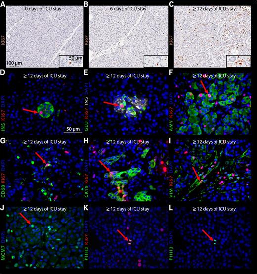 Figure 4. A–C: Immunostaining for the nuclear replication marker Ki67 in representative sections of human donor pancreas with 0 (A), 6 (B), and ≥12 (C) days of stay in the ICU. D–I: Double or triple immunostaining for Ki67 (red) in combination with insulin (INS; green) (D), glucagon (GLU; green) and insulin (white) (E), amylase (AMY; green) (F), CD68 (green) (G), CK19 (green) (H), or vimentin (VIM; green) (I) in representative sections of human donor pancreas with ≥12 days of stay in the ICU. J–L: Immunostaining for MCM7 or phospho–histone H3 (PHH3) and Ki67 in donors with ≥12 days of stay in the ICU. Nuclei are stained blue. Examples of the different replicating cell types are indicated with a red arrow.